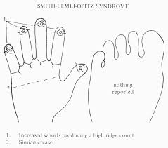 4 Hand Charts For Cri Du Chat Syndrome