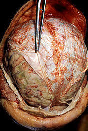 Adjective postmortem tests on the brain tissue of people who had been suffering from alzheimer's disease noun a postmortem showed that the. Autopsy Wikipedia