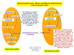 Image result for Homocystinuria