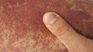 When blood leaks under the skin or from where small blood vessels joins together; Purpura Causes Diagnosis Treatment And Pictures
