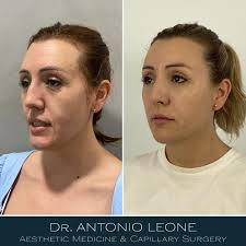 𝗗𝗥.𝗟𝗘𝗢𝗡𝗘 (@dr_antonioleone) • Instagram photos and videos