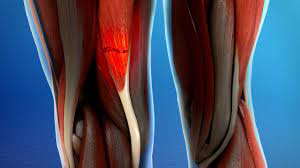 Get information about hamstring injuries (pulled hamstring), including symptoms, causes, treatment, and prevention. Hamstring Injury Treatment And Prevention Orthovirginia
