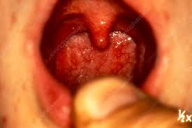 Image result for Pharyngitis
