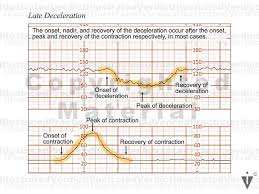 Image result for Late Deceleration