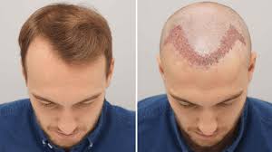 How To Do Hair Transplantation Sac Estetik Saglik