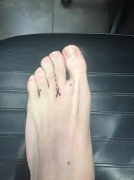 Although this condition does not impair one's ability to walk, run, jump, or. New Tattoo Decided To Decorate My Webbed Toes Pics
