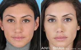 Check spelling or type a new query. Female Rhinoplasty Patient 1 Front View Rhinoplasty Rhinoplasty Nose Jobs Rhinoplasty Before And After