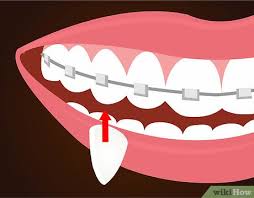 Similarly, it is asked, how do you get vampire teeth to stick without glue? How To Make Vampire Fangs If You Have Braces 12 Steps