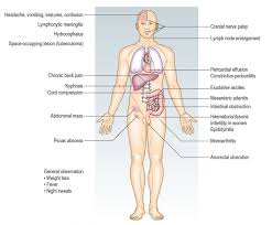 Image result for Extrapulmonary Tuberculosis