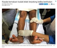 Berkhatan Kini Lebih Selamat Dan Tidak Menyakitkan Dengan Adanya Ismail Clamp