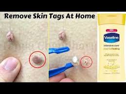 Youtube Skin Tag Removal Body Lotion How To Remove