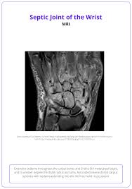 Image result for Septic Joint