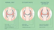 Image result for icd 10 code for m17.11