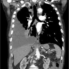 Patient was treated in hospital because of recurrent bilateral sanguineous pleural fluid … Pdf A Distinctive Colour Associated With High Iodine Content In Malignant Pleural Effusion From Metastatic Papillary Thyroid Cancer A Case Report