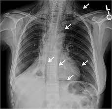 Pancreatic cancer may be diagnosed as diabetes, due to the fact that diabetes is often a symptom or risk factor of pancreatic cancer. Non Neoplastic Disorders Of The Mediastinum Pneumomediastinum Pulmonology Advisor