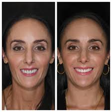 A smile reimagined. Porcelain veneers and implant crowns. DUBAI NEXT WEEK