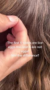 Image result for lice vs dandruff