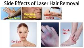 They are often the same effects you might notice after other types of hair removal, such as waxing. What Is The Cost Of Laser Treatment For Hair Removal