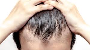 Generally, humans shed between 50 and 100 single hairs per day. Most Effective Treatments For Hair Loss Saikia Skin Care