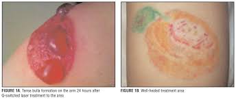 Also, laser tattoo removal treatment may be less effective in moderately dark or black skin or for unknown reasons. Treatment Of Large Bulla Formation After Tattoo Removal With A Q Switched Laser Jcad The Journal Of Clinical And Aesthetic Dermatology