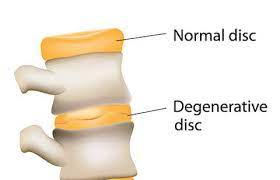 Degenerative Disc Disease Atlanta Spine Center Atlanta