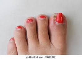 Image result for Paronychia feet