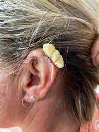 ear cancer is cancer which develops in the ear, the ear canal or middle ear and inner ear. Alena Sharp On Twitter 1 2 I Debated Posting This But Thought Maybe It Could Shed Some Real Light On Skin Cancer Sarah And I Get Our Skin Checked Yearly And They Found