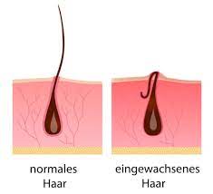 eingewachsenes haar sos tipps dauerhafte losung faces of fey