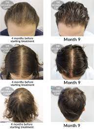 I am an 18 year old year old female experiencing hair fall/thinning. Success Story Alert New Male Hair Loss Treatment Entry