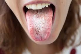 Image result for Oral thrush roof of mouth