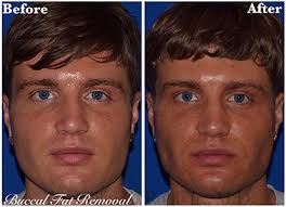 The bichat bags or balls are two clusters of fat found deep in the cheeks. Buccal Fat Removal Alpharetta Facial Reshaping Atlanta