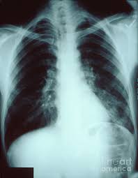 How long will it take my 5 year old to recover from left lower lobe pneumonia? answered by dr. Left Lower Lobe Pneumonia Photograph By Science Source