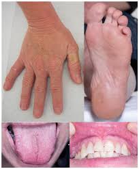 Cutaneous Expression of Familial Cancer Syndromes