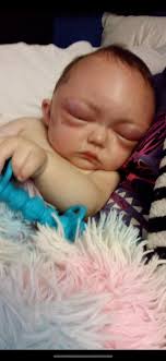 Tricks for syringe feeding after cleft repair surgery?