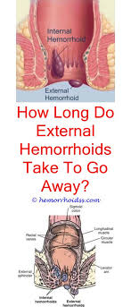 Pin On Bleeding Hemorrhoids Treatment