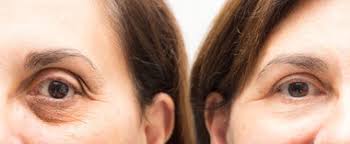 1280 x 720 jpeg 81 кб. Plasma Dark Eye Circles Leicester Laser Clinic
