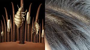Rinse your hair with this water. 12 Natural Head Lice Remedies Never To Ignore 7 Minute Read
