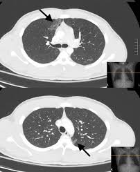 Image result for Pulmonary Contusion