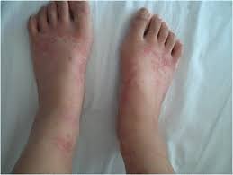 This is a classic example of palpable purpura. Palpable Purpura On Both Of The Patient S Ankles And Feet On Hospital Download Scientific Diagram