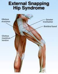 Snapping Hip Syndrome Robert Howells