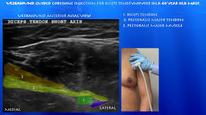 Image result for Biceps Tendon Injection