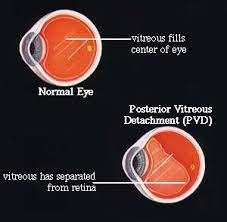 How does a retinal detachment manifest itself? Posterior Vitreous Detachment What It Is And What Causes It