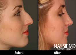 Pin By Katie On Rhinoplasty Before After Rhinoplasty Nose Jobs Rhinoplasty Nose Surgery