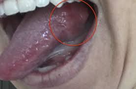 Image result for dental cancer