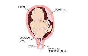 Tali pusat terdapat antara pusat janin dan permukaan fetal plasenta. Prolaps Tali Pusat Patofisiologi Diagnosis Penatalaksanaan Alomedika