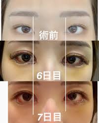 オンナ on twitter タレ目 目頭 切開