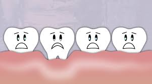 How can i make my. Can Receding Gums Grow Back Naturally Delta Dental Of Colorado Blog
