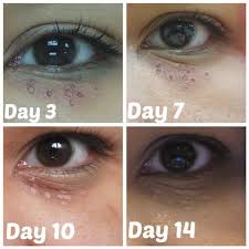34 clinics 58 medical doctors & dermatologists malaysia book of records:klinik pakar kulit, estetik & laser terbesar di malaysia ️top 10 awards 2019 drkoskincare.com. Illy Ariffin Com Ko Skin Specialist Review Milia Seed Removal And Skin Peeling Treatment