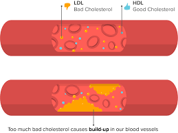 Image result for LDL Cholesterol