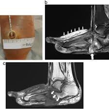 The severity of the injury can vary from simple to complex, involving many joints and bones in the midfoot. Pdf Die Rolle Der Radiologischen Bildgebung Beim Charcot Fuss